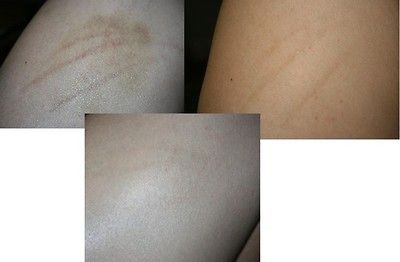   Scars Stretch Marks Uneven Tone Face Body Dry Skin Care BIO OIL
